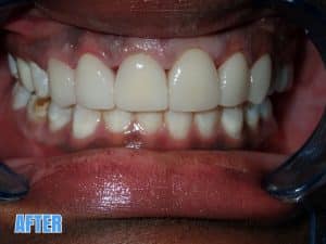 Veneers mableton ga