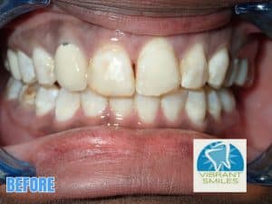 Veneers mableton ga