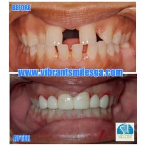 Before and After Veneers