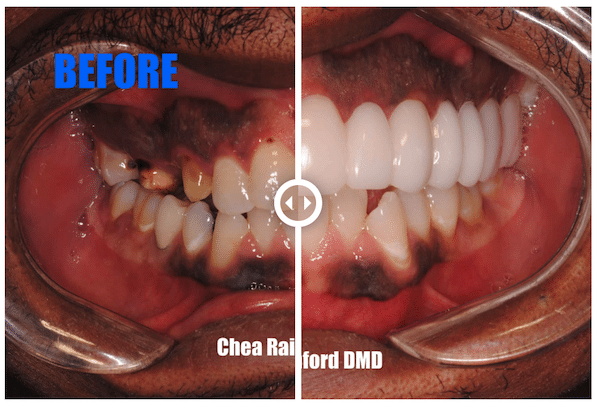 snap on smile before and after vibrant smiles mableton